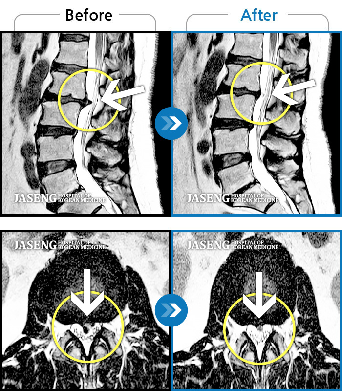 자생한방병원 치료사례 MRI로 보는 치료결과-허리를 굽히거나 같은 자세 유지 시 통증이 심하여 내원하였습니다.