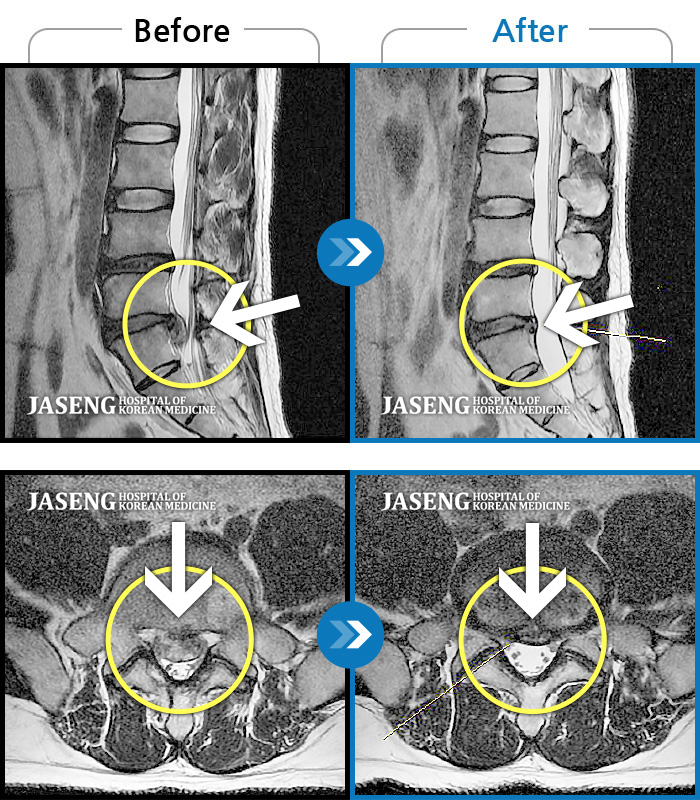 자생한방병원 치료사례 MRI로 보는 치료결과-처음 내원 시 허리통증과 왼쪽 다리 저림, 당김, 터질 듯한 통증으로 보행이 어려울 정도로 힘든 상태였습니다.