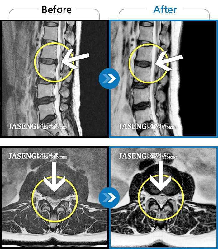 자생한방병원 치료사례 MRI로 보는 치료결과-허리통증 및 골반부위 통증으로 일상생활이 불가능했습니다.