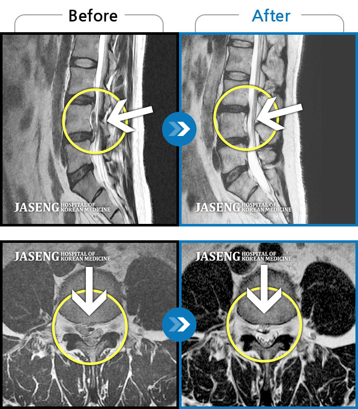 자생한방병원 치료사례 MRI로 보는 치료결과-운동하다 삐끗한 후 허리디스크가 터지고 흘러올라가 극심한 통증을 호소하셨습니다.