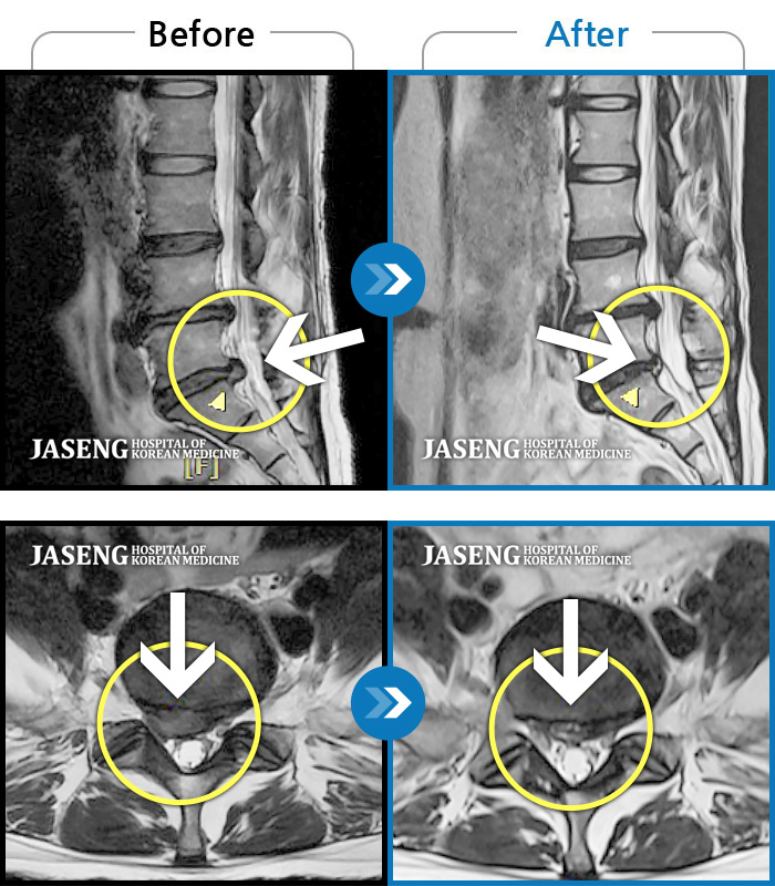 자생한방병원 치료사례 MRI로 보는 치료결과-하부요추, 골반 양측 묵직한 통증, 우측하지 후면으로 이어지는 통증  