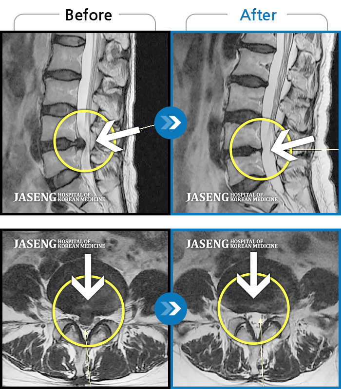 자생한방병원 치료사례 MRI로 보는 치료결과-우측 하요추부 통증과 좌측 하지 저림