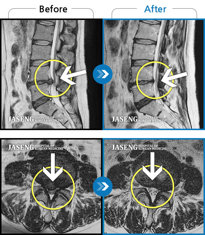 자생한방병원 치료사례 MRI로 보는 치료결과-무거운 물건을 든 후 삐끗 해 앉아있기가 너무 힘들어요