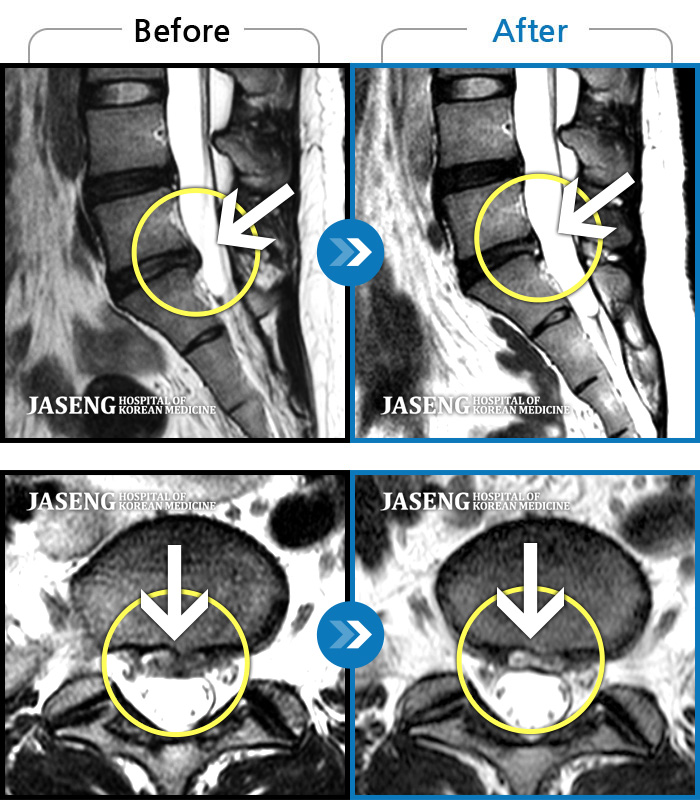 자생한방병원 치료사례 MRI로 보는 치료결과-허리 아래쪽으로 끊어질듯한 통증과 함께 양쪽 하지 방사통으로 인해 걸을 수 가 없었음
