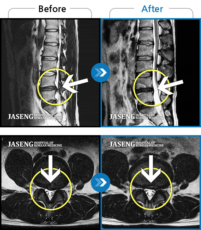 자생한방병원 치료사례 MRI로 보는 치료결과-계속 아파서 일을 일주일에 2번밖에 못해요.