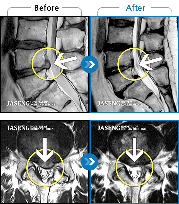 자생한방병원 치료사례 MRI로 보는 치료결과-좌측 다리 저림 증상이 너무 심하여 야간에 주무시기도 어려운 상태 