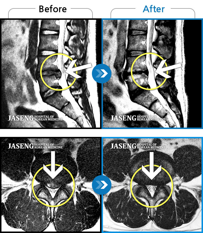 자생한방병원 치료사례 MRI로 보는 치료결과-허리통증 및 왼쪽 다리 통증으로 일상생활이 불가능했습니다.