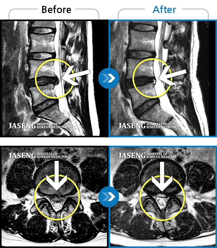 자생한방병원 치료사례 MRI로 보는 치료결과-허리통증 심하여 걷기 힘들고 일상 생활이 불가능했습니다.