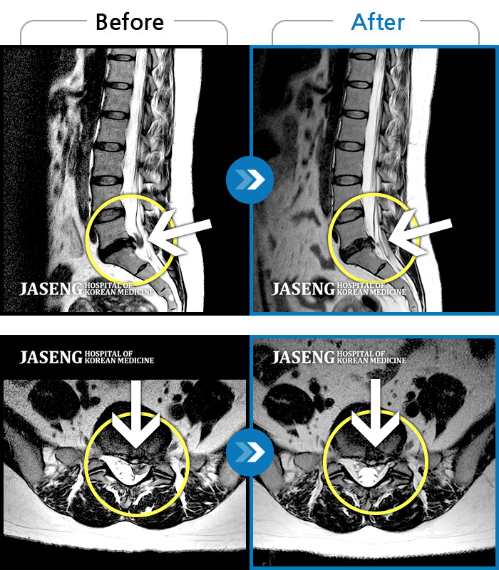 자생한방병원 치료사례 MRI로 보는 치료결과-통증으로 아기를 안지 못하던 여자분입니다