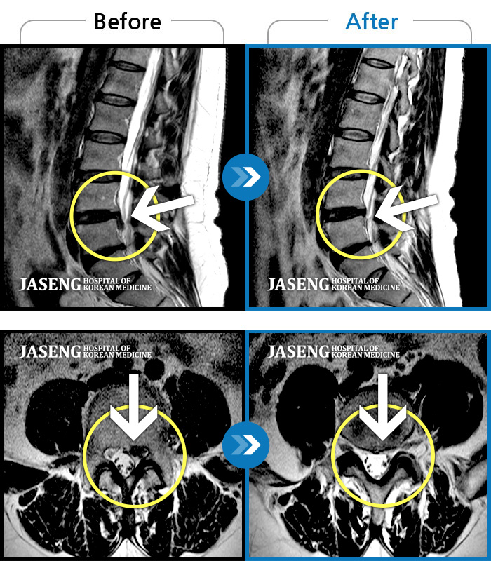 자생한방병원 치료사례 MRI로 보는 치료결과-허리 골반 통증이 있고 허리 숙일 때 불편감있다.
