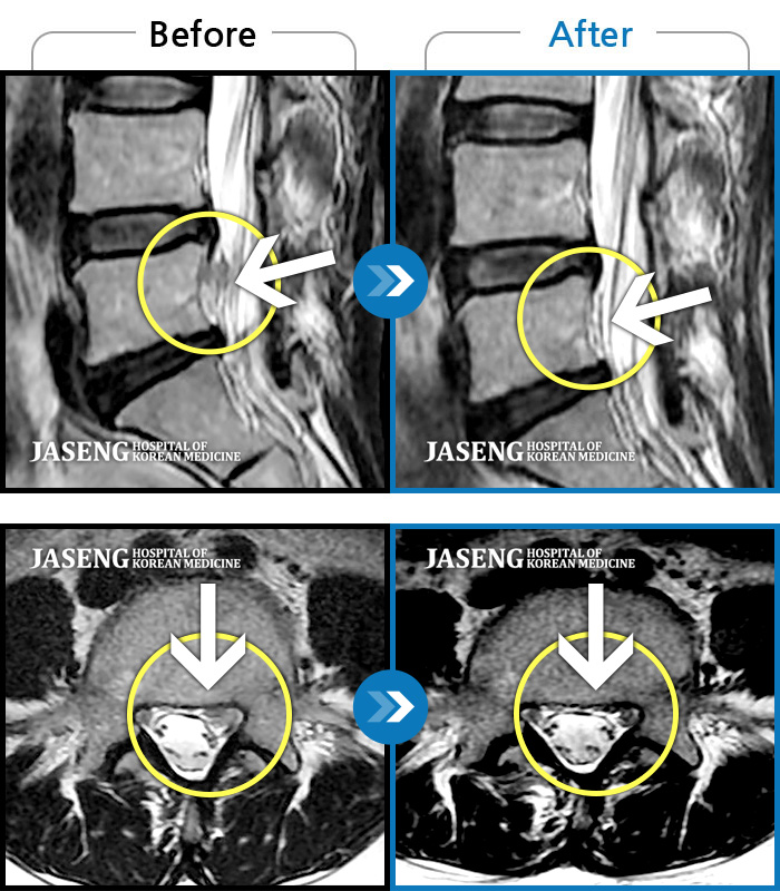 자생한방병원 치료사례 MRI로 보는 치료결과-의자 위를 여러 번 올라갔다 내려갔다 반복한 뒤 극심한 하요부 통증 및 좌측 하지부 저림