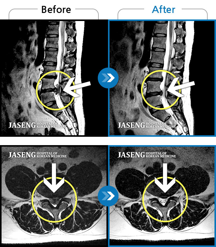 자생한방병원 치료사례 MRI로 보는 치료결과-좌측 다리 뒤쪽으로 통증이 심해서 걸어다니기 힘들어요