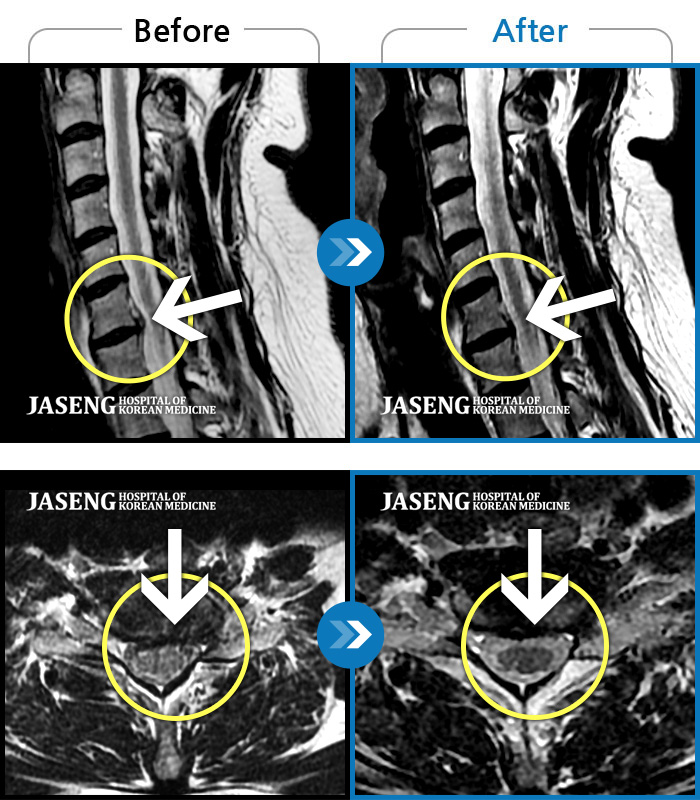 자생한방병원 치료사례 MRI로 보는 치료결과-목통증, 왼쪽 팔저림, 두통, 잇몸통증까지 심해 일상생활 불가