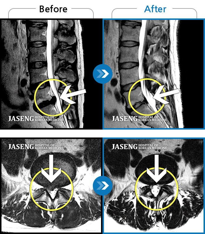 자생한방병원 치료사례 MRI로 보는 치료결과-하지부 부종 및 저림 증상이 사라지지 않고 지속됨