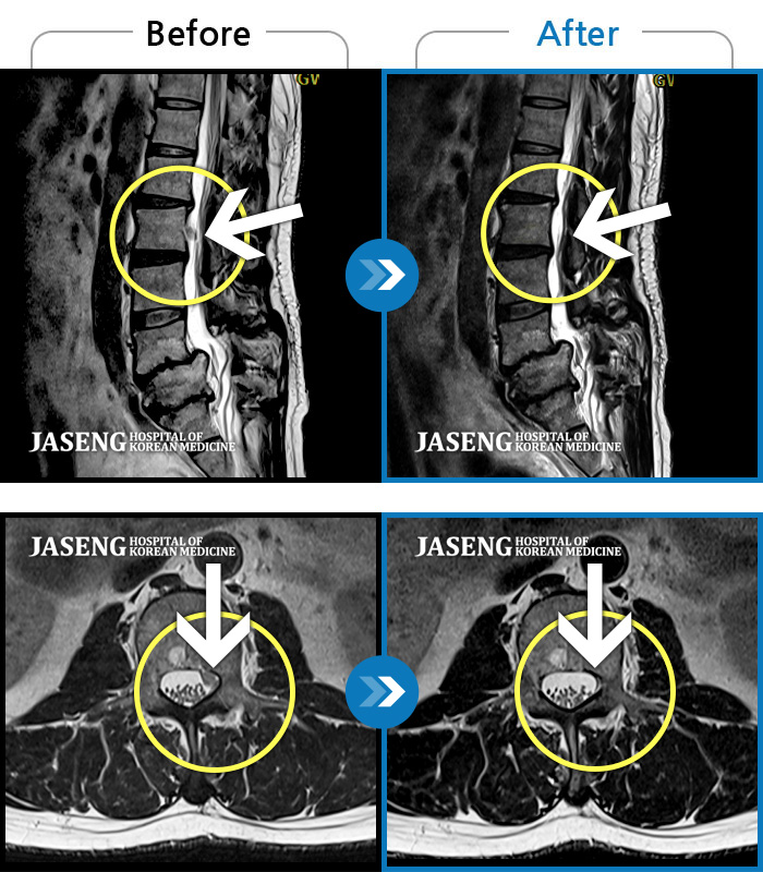 자생한방병원 치료사례 MRI로 보는 치료결과-좌측 허리 통증으로 허리를 반듯이 펴고 서있기 힘들어 내원하셨습니다.