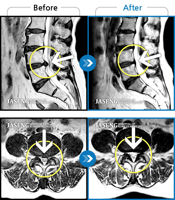 자생한방병원 치료사례 MRI로 보는 치료결과-허리통증으로 일상이 멈췄다.