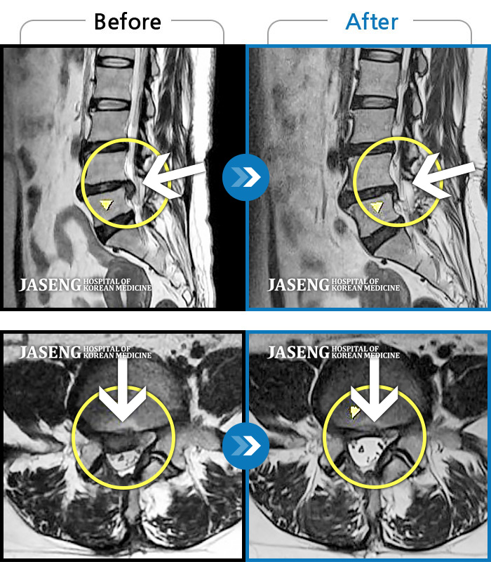 자생한방병원 치료사례 MRI로 보는 치료결과-양측 허리의 묵직한 통증 및 기침 시 증상이 심화되어 내원하셨습니다.