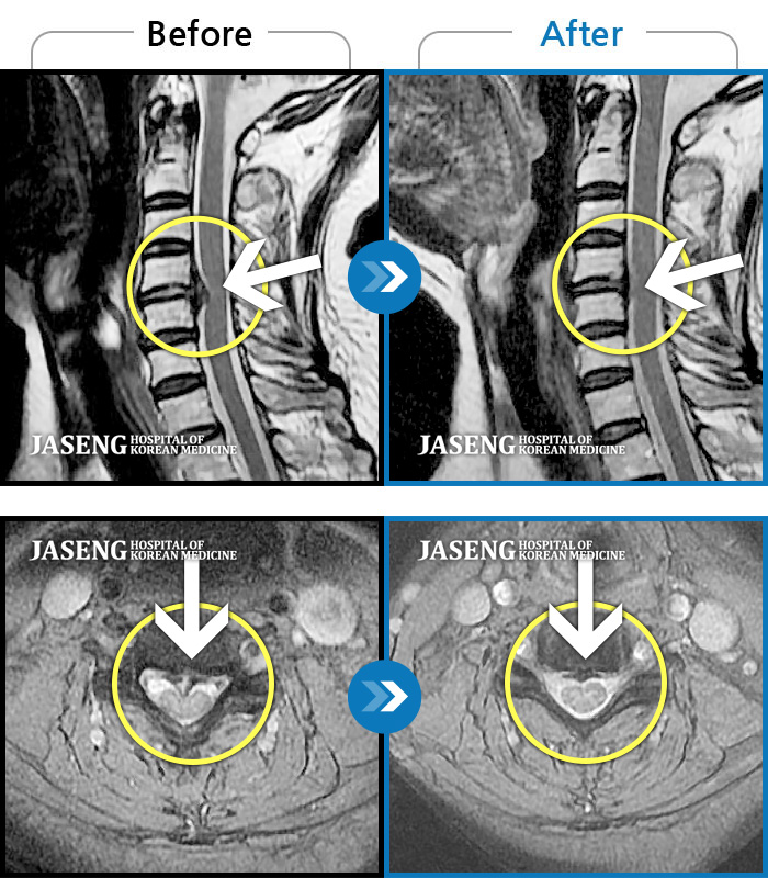 자생한방병원 치료사례 MRI로 보는 치료결과-목과 등이 찌르듯이 날카롭게 아프다.