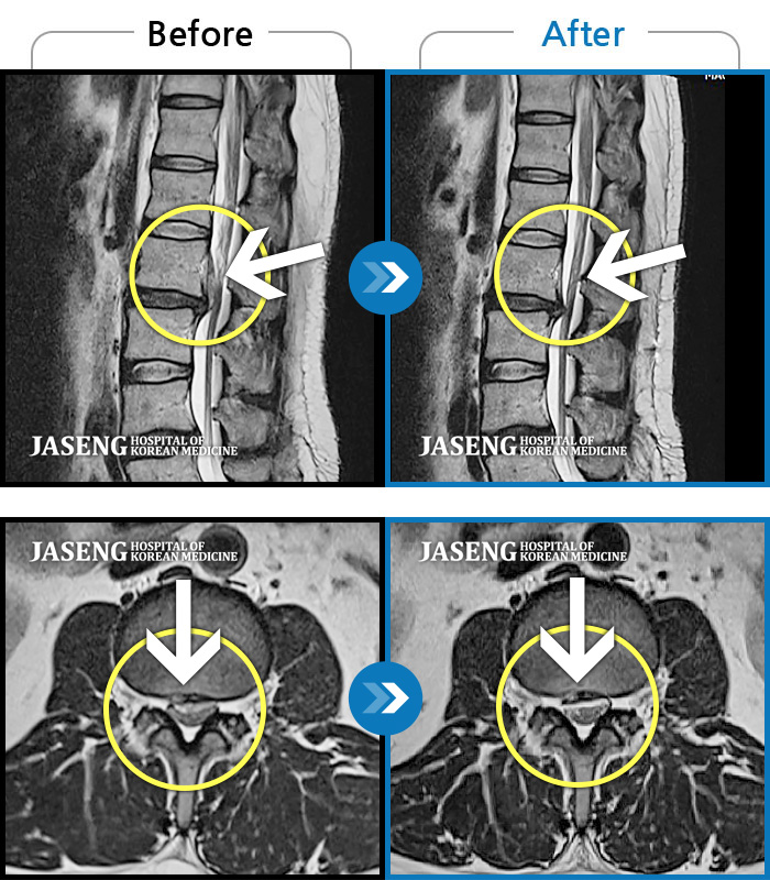 자생한방병원 치료사례 MRI로 보는 치료결과-통증으로 허리를 펴기가 어렵고 우측 다리 통증이 보행이 어렵다.