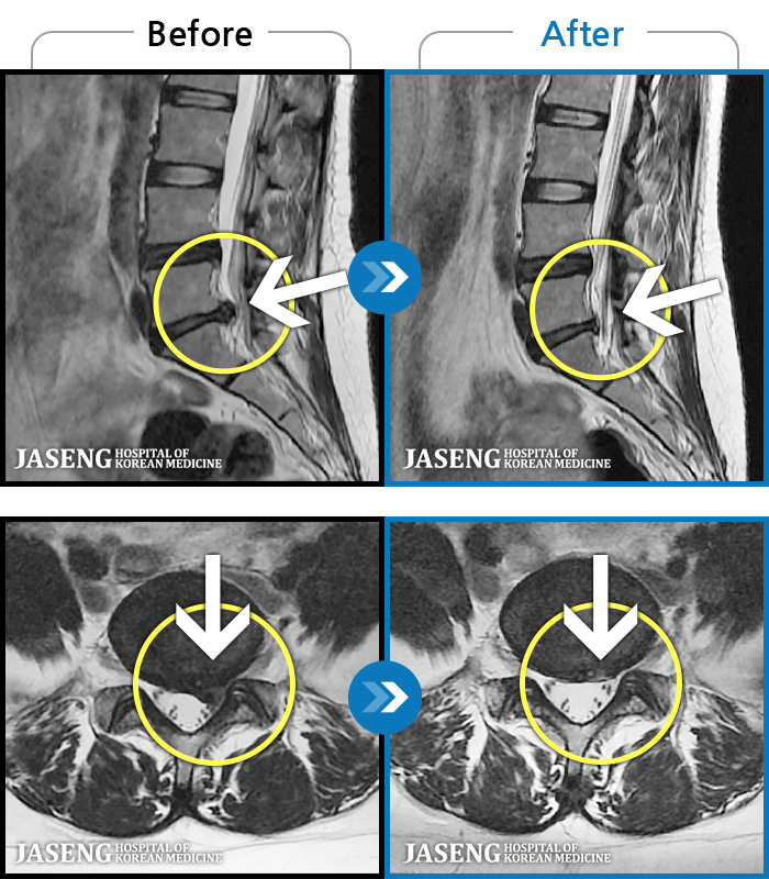자생한방병원 치료사례 MRI로 보는 치료결과-2-3년간 디스크로 허리통증과 하지방사통으로 여러 치료하였으나 나아지지 않는 증상
