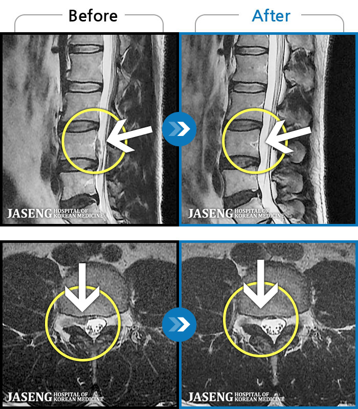 자생한방병원 치료사례 MRI로 보는 치료결과-우측 허리, 골반이 아프고 우측 하지 다리 당김이 극심했다.