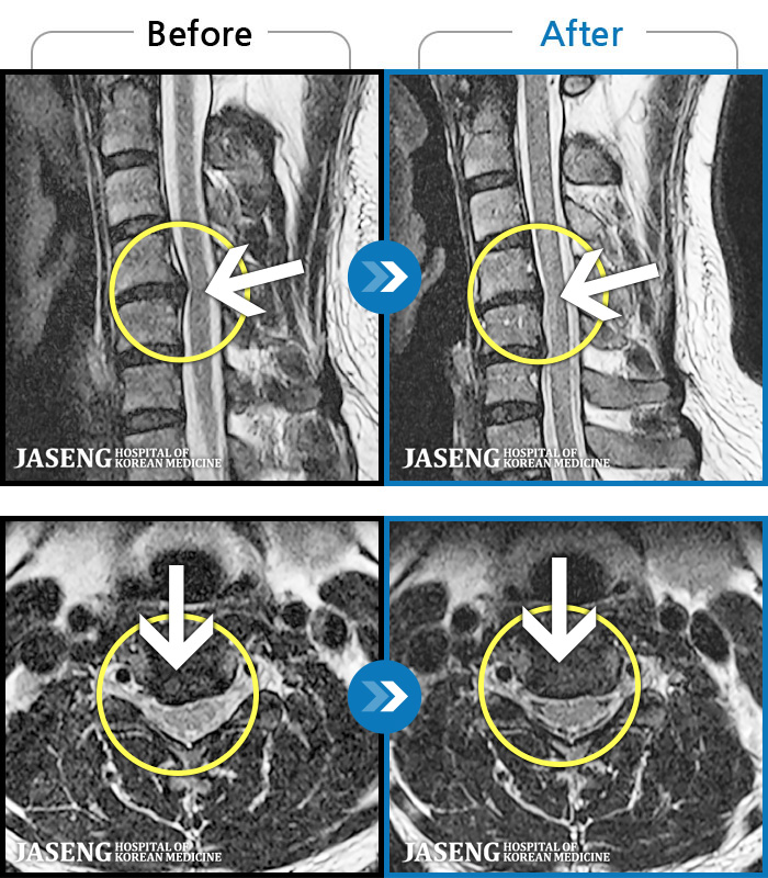 자생한방병원 치료사례 MRI로 보는 치료결과-양측 목, 어깨, 팔에 찌릿한 통증으로 일상생활에 지장이 있었습니다.
