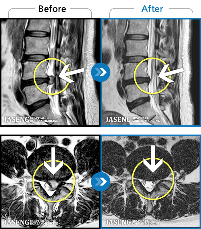 자생한방병원 치료사례 MRI로 보는 치료결과-처음 내원 시 허리와 좌측 골반 통증이 심한 상태였습니다.
