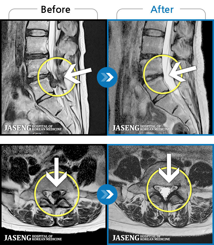 자생한방병원 치료사례 MRI로 보는 치료결과-좌측 허벅지와 종아리가 찌릿하고 묵직한 통증이 있어요.
