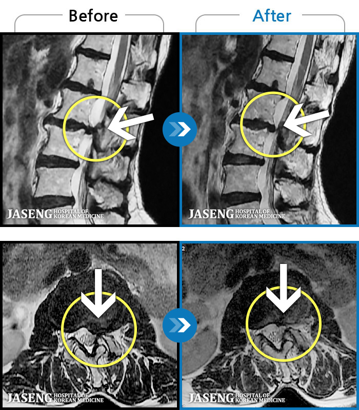 자생한방병원 치료사례 MRI로 보는 치료결과-허리가 찌릿찌릿하고 찢어질 것 같은 통증