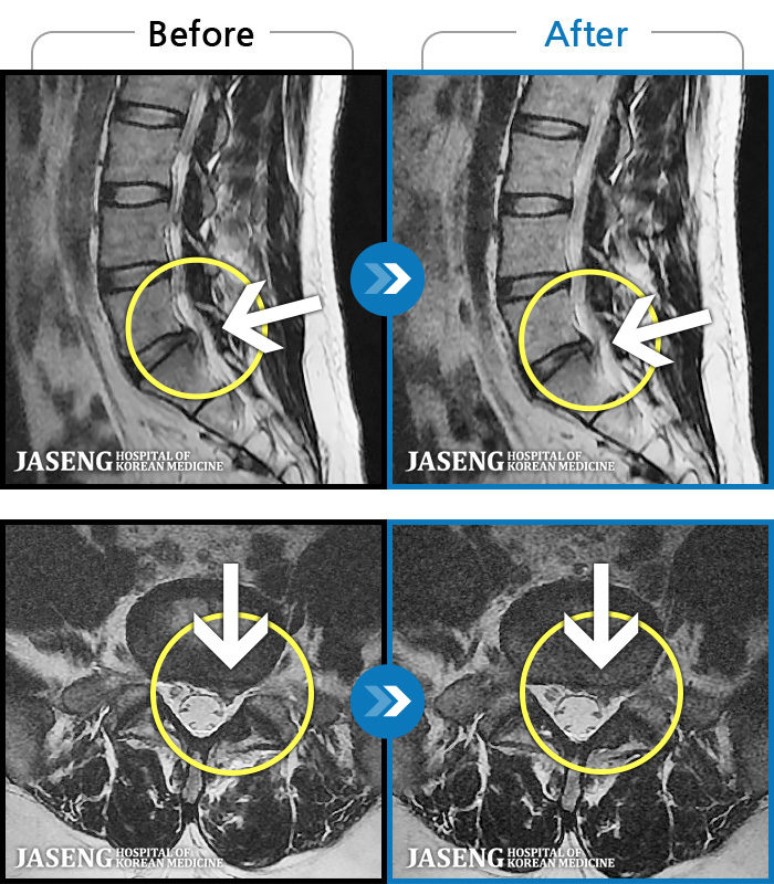 자생한방병원 치료사례 MRI로 보는 치료결과-통증이 극심하고 수면을 방해할 정도의 야간통이 있으며 보행 시 통증으로 절뚝이는 상태로 일상생활이 힘든 상태였습니다.