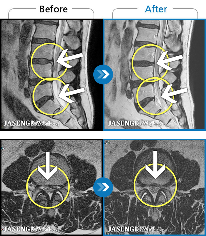 자생한방병원 치료사례 MRI로 보는 치료결과-좌측 허리 통증 및 골반 통증이 심하여 걷는 것도 힘든 상태로 내원하셨습니다. 