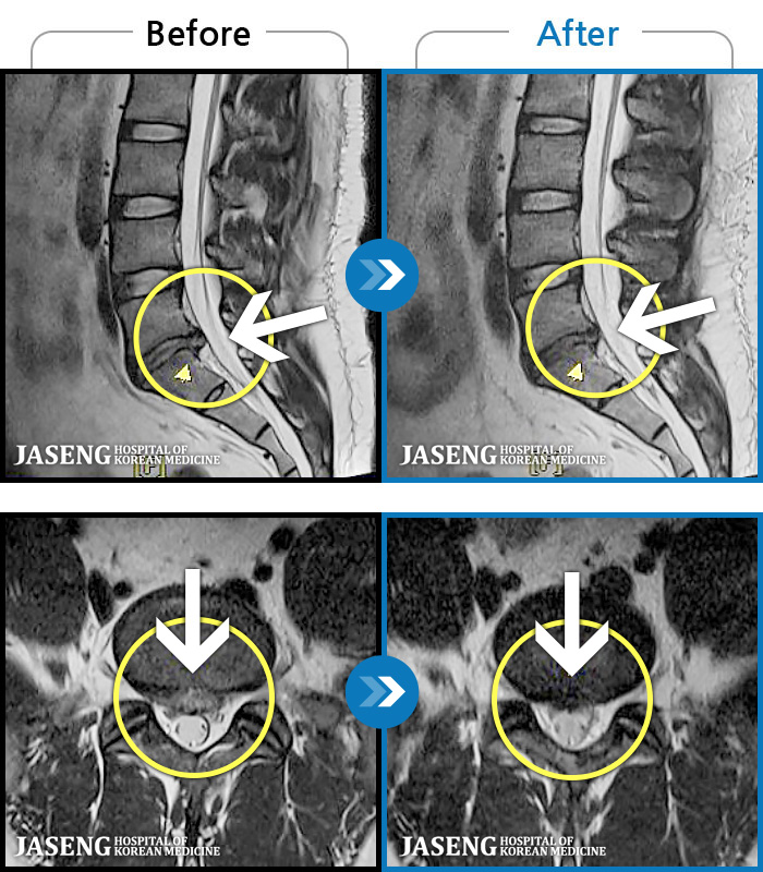 광주자생한방병원_MRI 치료 전후 사례