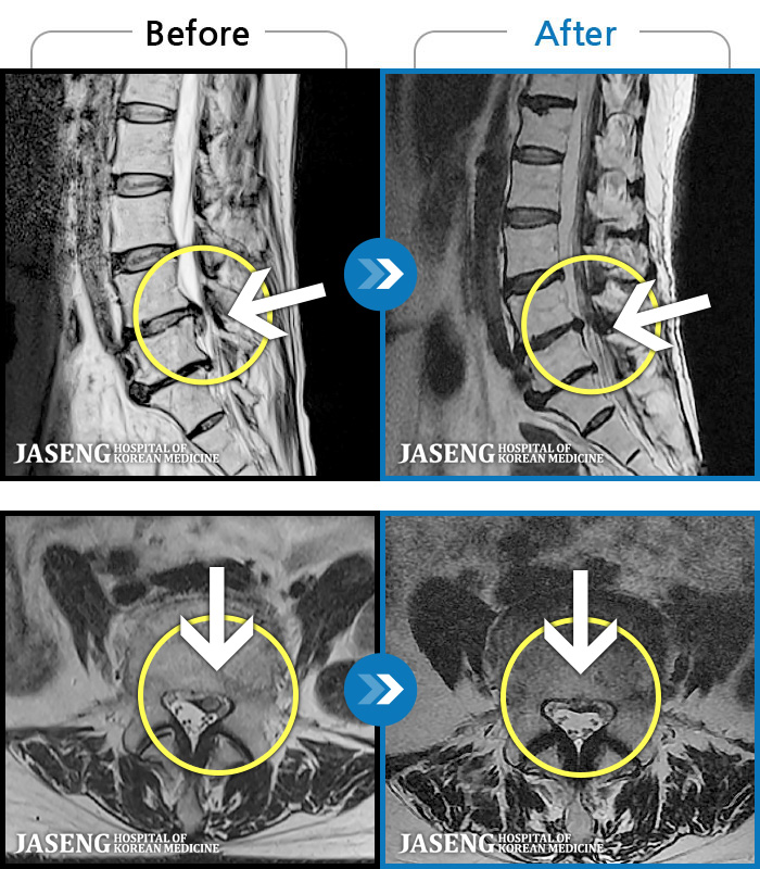 일산자생한방병원-MRI 치료 전후 사례