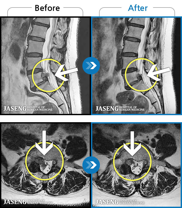 보라매자생한방병원-MRI 치료 전후 사례