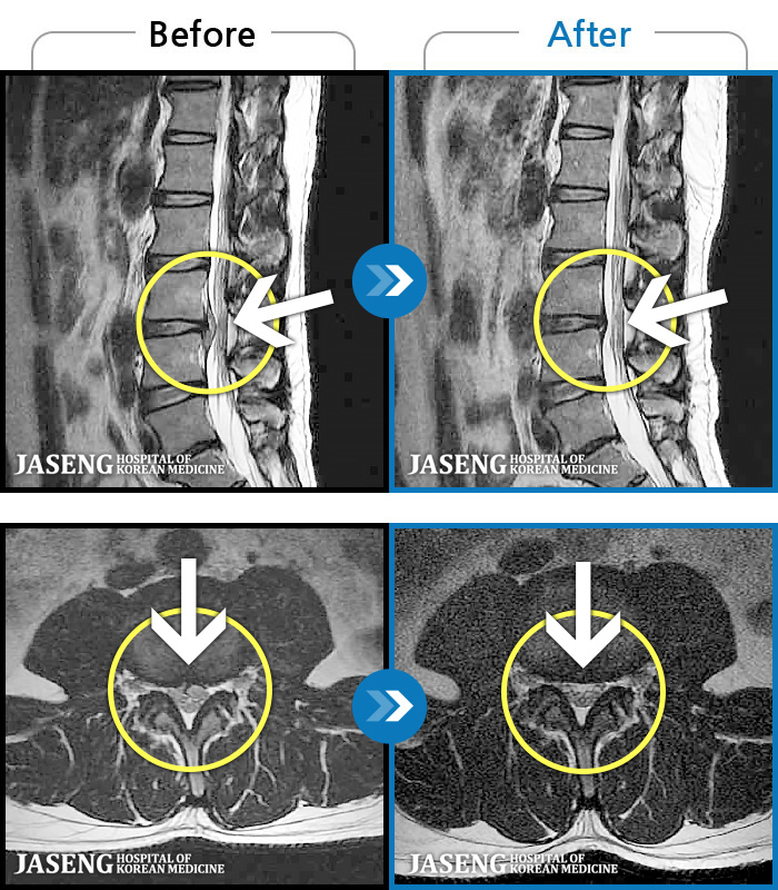 보라매자생한방병원-MRI 치료 전후 사례