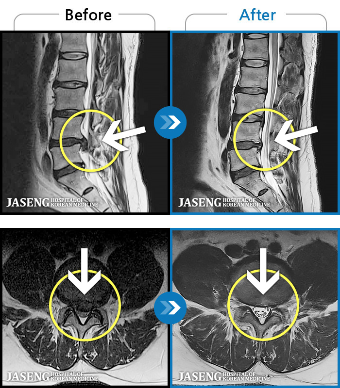 보라매자생한방병원-MRI 치료 전후 사례