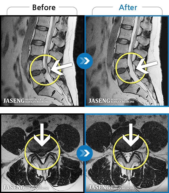 보라매자생한방병원-MRI 치료 전후 사례