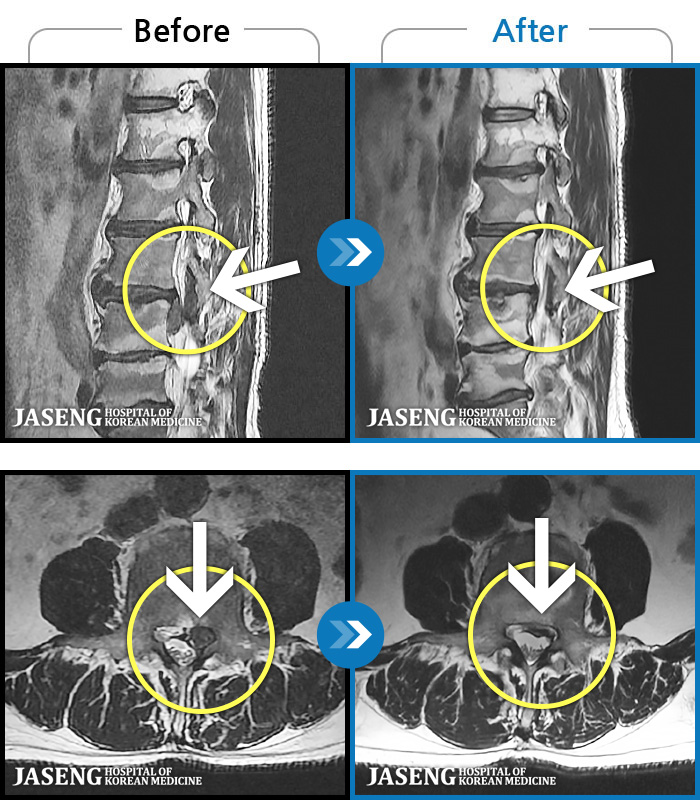 청주자생한방병원-MRI 치료 전후 사례