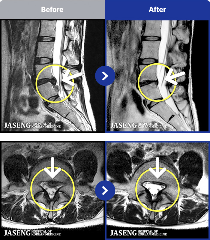 자생한방병원 MRI 치료 전후 사례