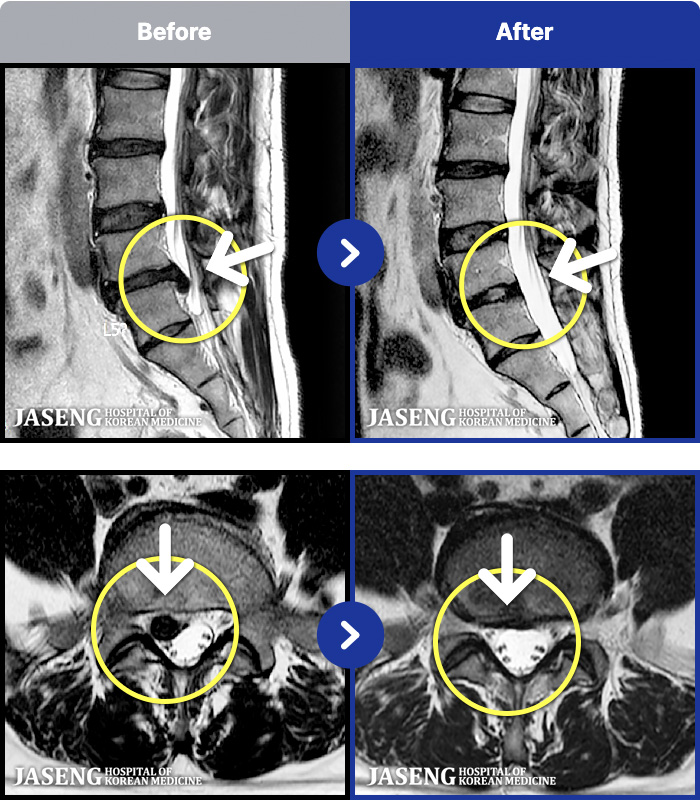 자생한방병원-MRI 치료 전후 사례