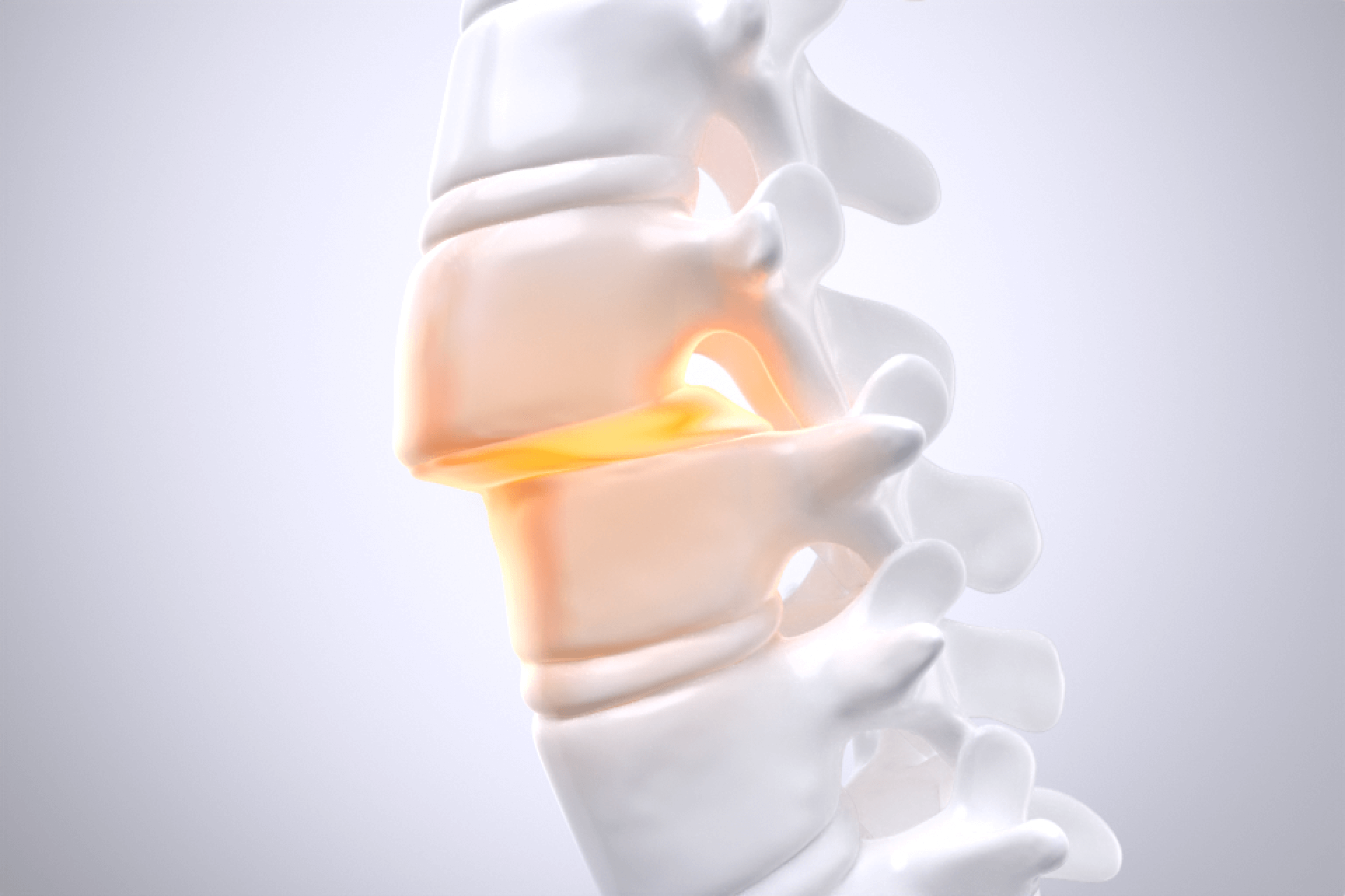 척추전방전위증