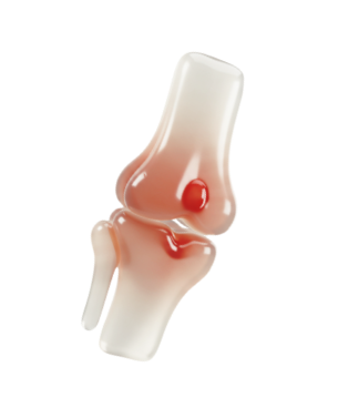 무릎 관절 부위가 붉게 표시된 성장장애 관련 3D 관절 이미지