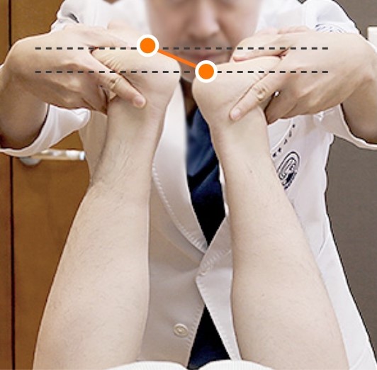 추나요법 전후 다리 길이 비교 이미지: 치료 전에는 11.2mm 차이가 있음