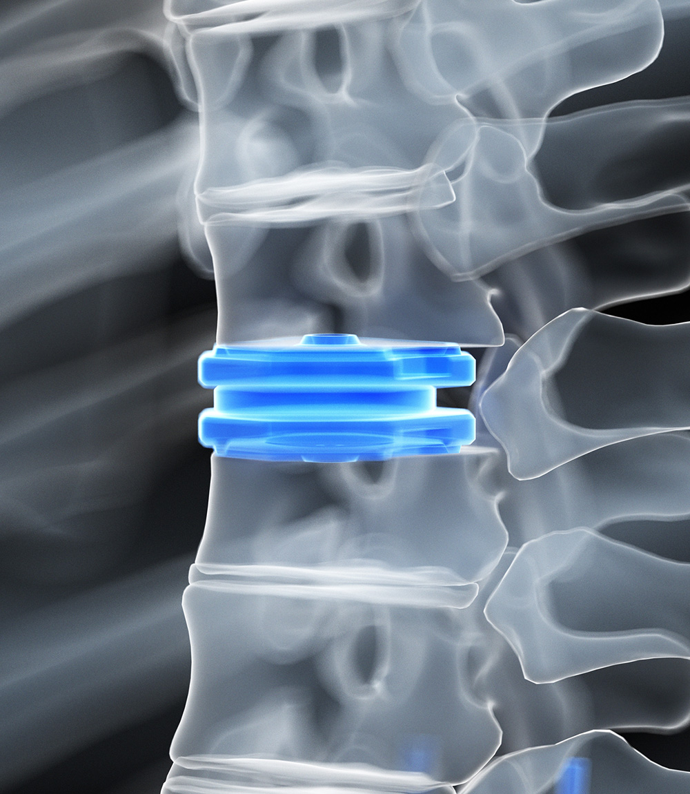 꾸준한 임상연구를 바탕으로 척추치료의 새로운 글로벌 표준 선도