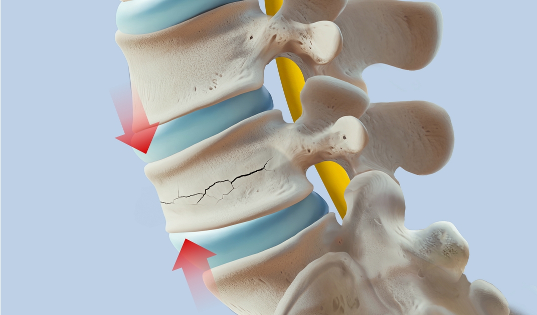 척추압박으로 허리가 골절
