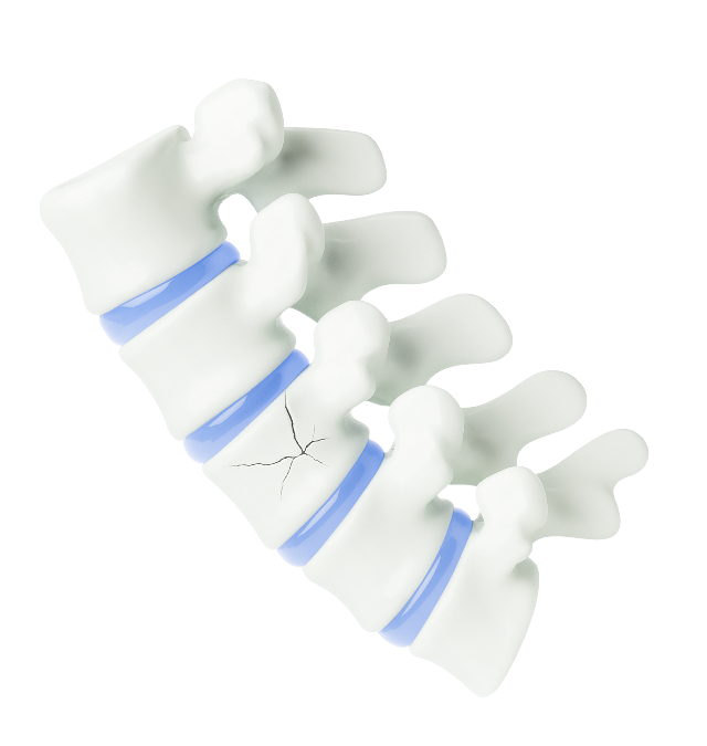 척추 압박골절을 나타내는 척추뼈 이미지, 특정 부위가 금 간 듯 표시된 3D 모델